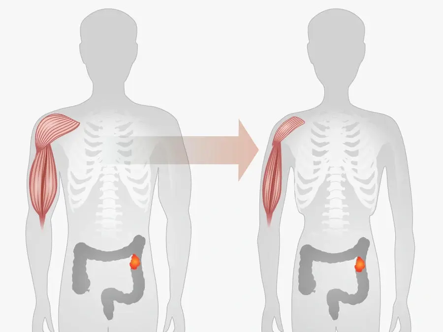 How Do Myostatin Supplements Help in Cancer Cachexia