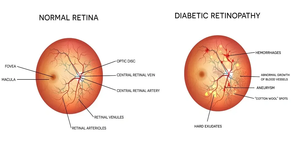 How Does Poor Blood Flow Affect Diabetic Vision