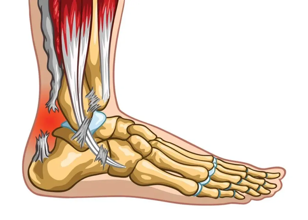 How Long Does Tendon Rehabilitation Take After Injury