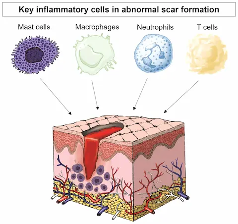 Inflammation Impact Scar Formation and Healing
