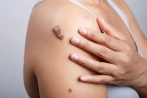 Keloid Treatment Therapy