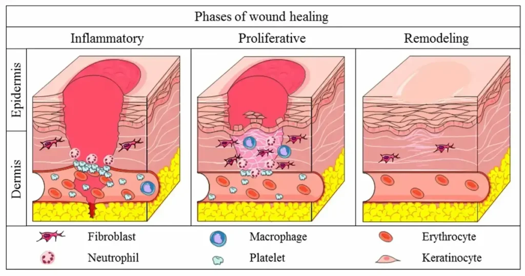 Phases of wound healing inflammatory, proliferative, and remodeling with fibroblasts, macrophages, keratinocytes, and collagen regeneration.