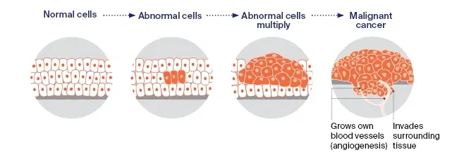 Growth Hormone Peptides in Cancer Development
