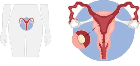 Factors Affect Implantation after HMG Hormone Stimulation
