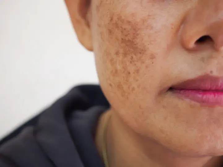 MC1R Affect Skin Pigmentation