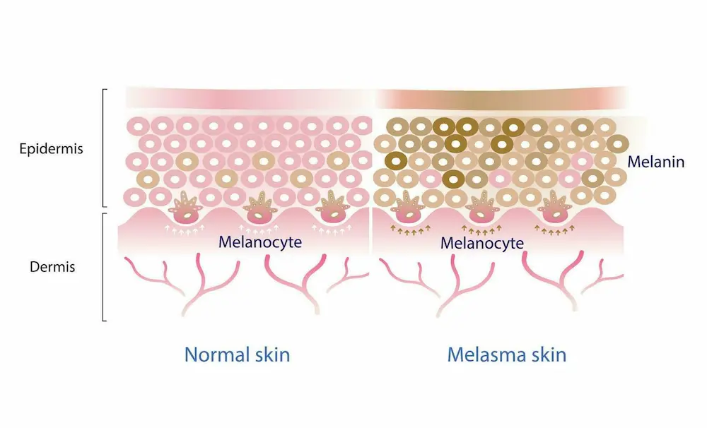  Skin Difference structure