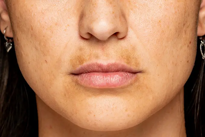 Tanning Peptide Melanotan 1 or Melanotan 2