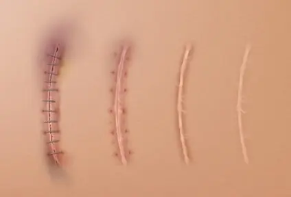 Healing Peptides Reduce Scar Formation