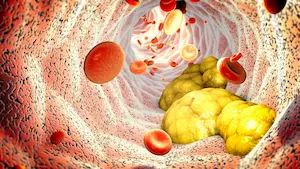 Stubborn Fat Areas So Hard to Lose