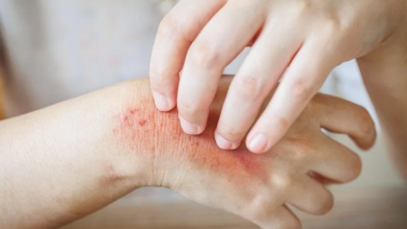 Fungal Infections