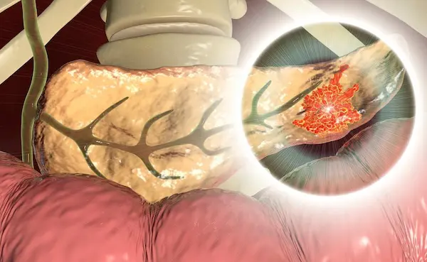 PNC-27 Peptide Kills Cancer Cells