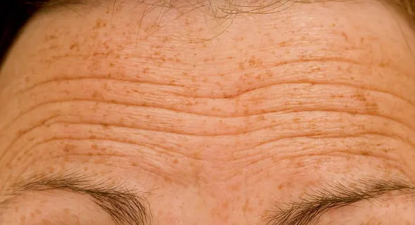 Botox Substitute for Wrinkle