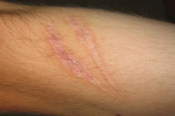 Tissue Repair Peptide Therapy