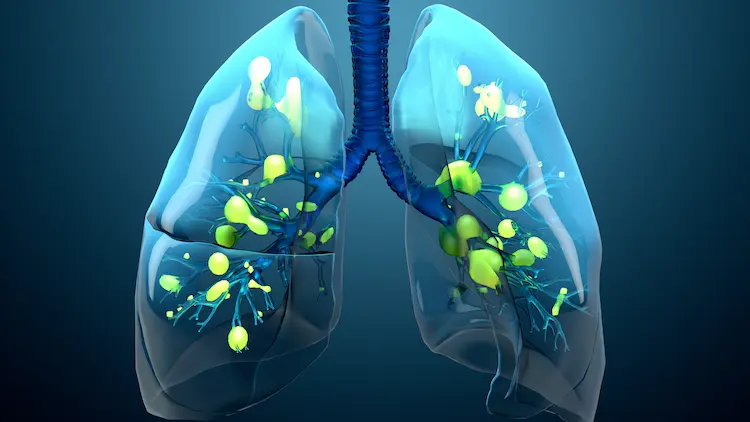 3D illustration of airways with green-yellow mucus buildup, showing airflow obstruction in COPD